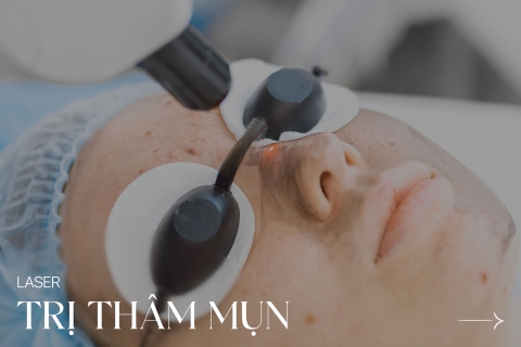 Laser trị thâm mụn